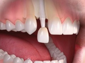 front-tooth-dental-implant-cost-los-angeles