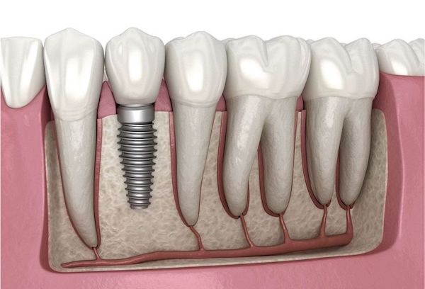how-much-are-dental-implants-in-los-angeles