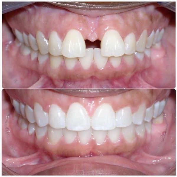 invisalign-before-and-after-gaps