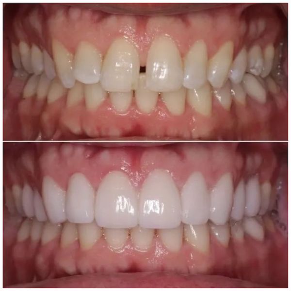 invisalign-before-and-after-los-angeles-bottom-teeth