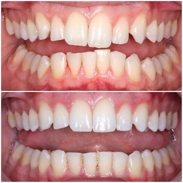 invisalign-before-and-after-los-angeles-lower-teeth