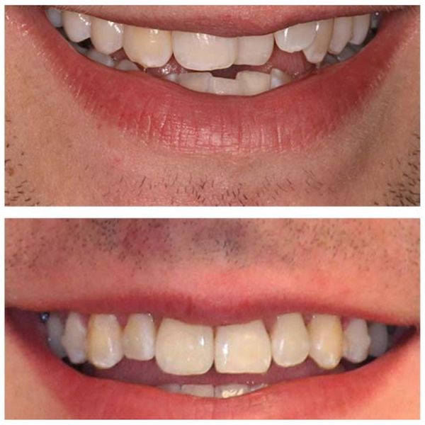 invisalign-express-before-and-after