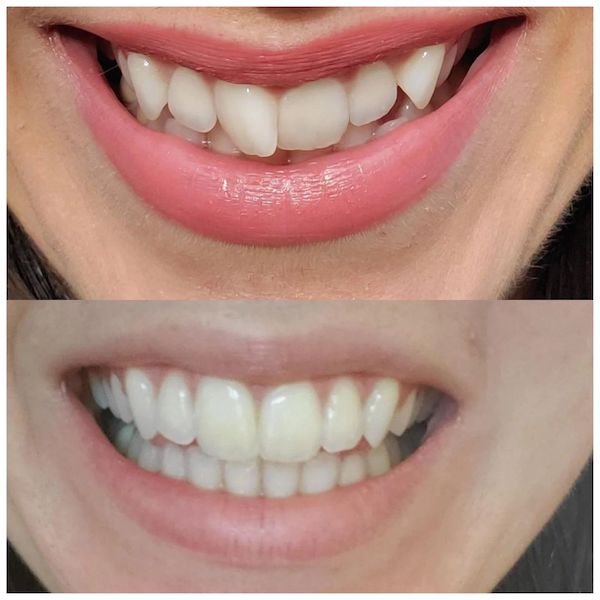 invisalign-express-results