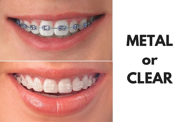 metal-braces-or-clear-braces-santa-clarita
