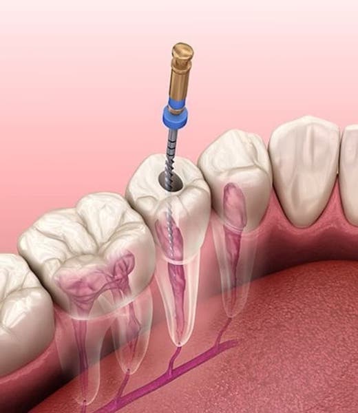 root-canal-cost-without-insurance-of-lower-left-premolar-tooth