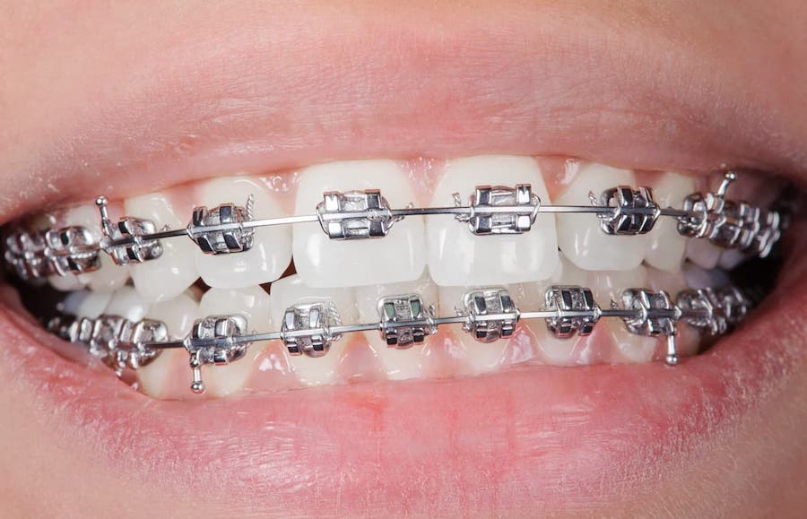 santa-clarita-braces-orthodontist