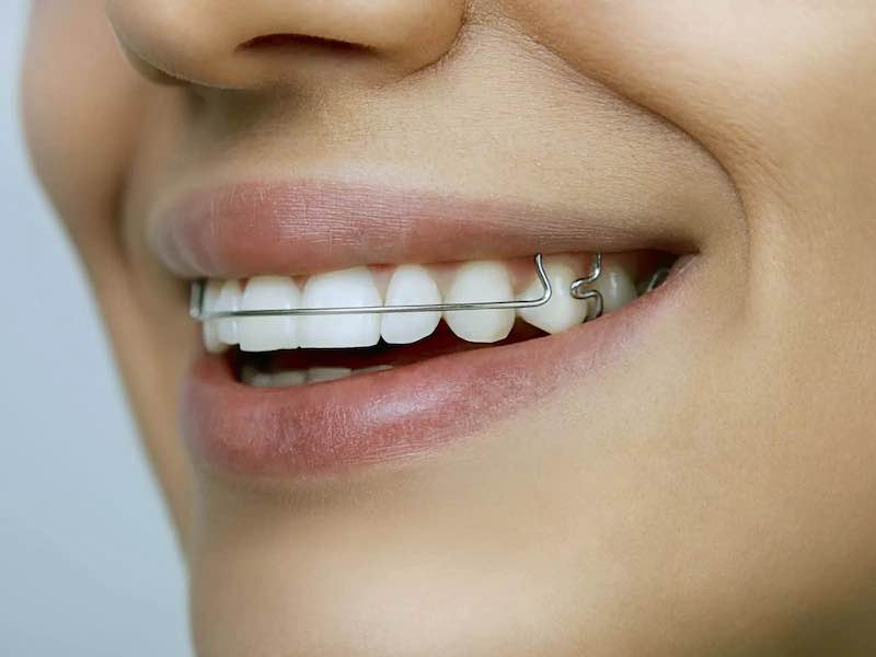 smiling-patient-wearing-orthodontic-braces-santa-clarita