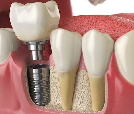 dental-implant-and-bone-graft-cost-los-angeles-dental-clinic