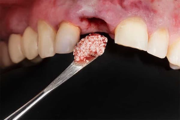 dental-implant-bone-graft