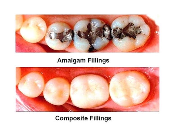 Low-cost-dental-filling-los-angeles