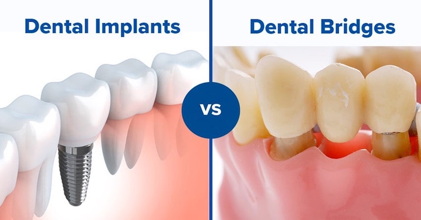 dental-bridges-vs-dental-implants