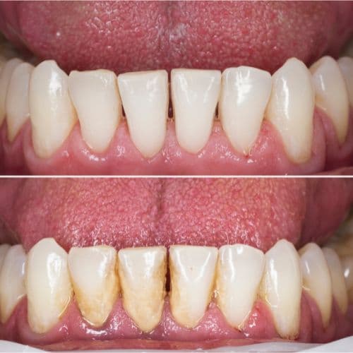 dental-deep-cleaning-before-and-after-lower-teeth