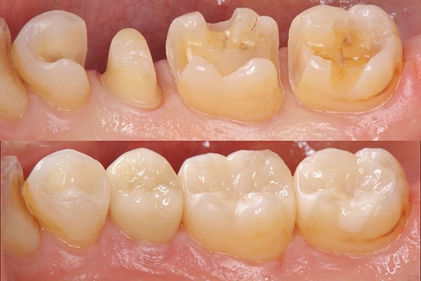 dental-onlay-before-and-after-at-best-la-dental-clinic