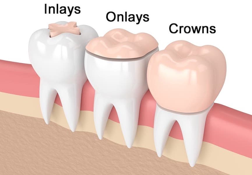 dental-onlay-vs-crown-los-angeles