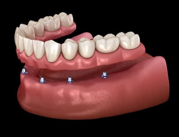 denture-implants-cost-los-angeles