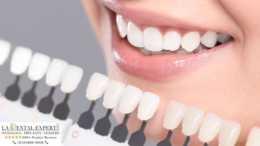 getting-white-shade-of-teeth-before-and-after-teeth-whitening