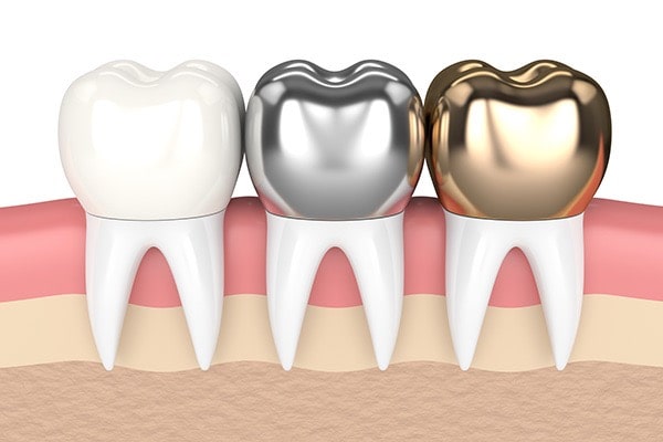 gold-crown-vs-porcelain-dental-crown