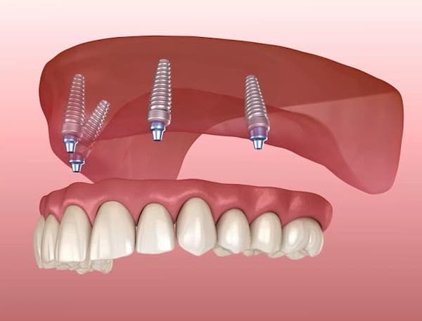 implant-supported-denture-los-angeles