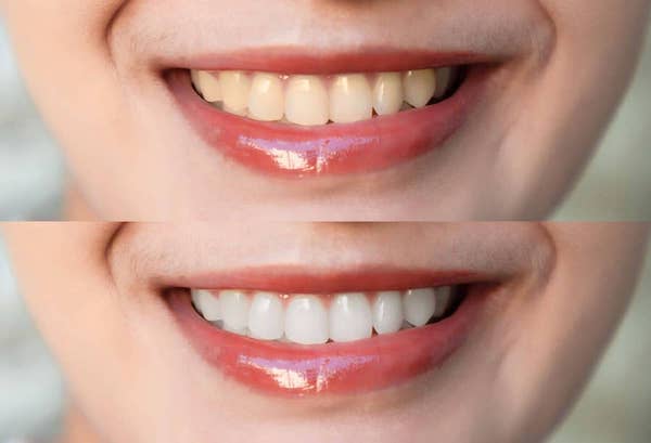 kor-whitening-before-and-after
