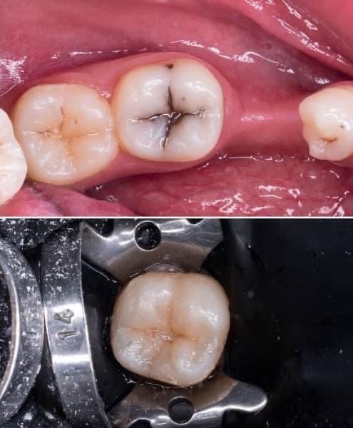 los-angeles-dental-filling-on molar-tooth-before-and-after