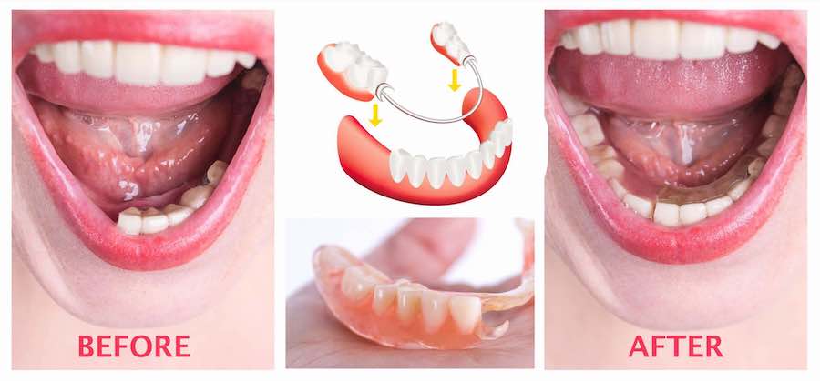 partial-dentures-cost-and-before-after-in-los-angeles