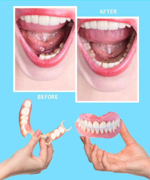 patient-with-missing-lower-teeth-and-flipper-partial-denture-before-and-after-cost