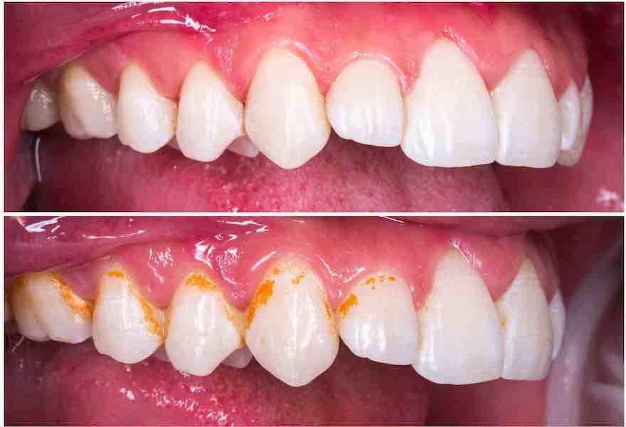 periodontal-deep-cleaning-before-after-upper-teeth