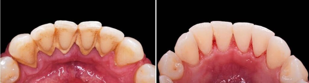 periodontal-deep-cleaning-los-angeles