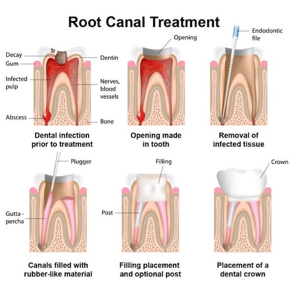root-canal-crown-los-angeles