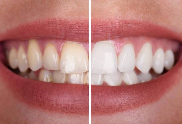 teeth-bleaching-before-and-after-los-angeles