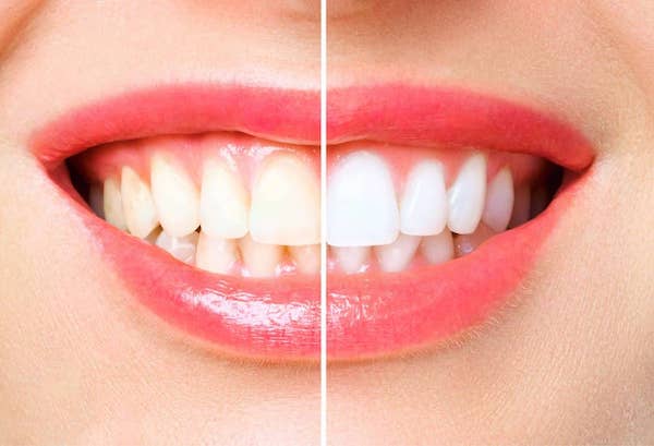 teeth-whitening-before-and-after-los-angeles