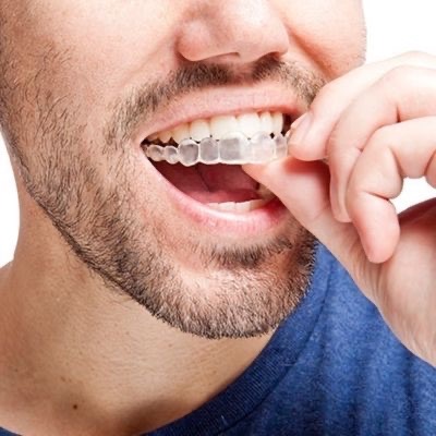 can-you-get-invisalign-with-bridge-in-los-angeles