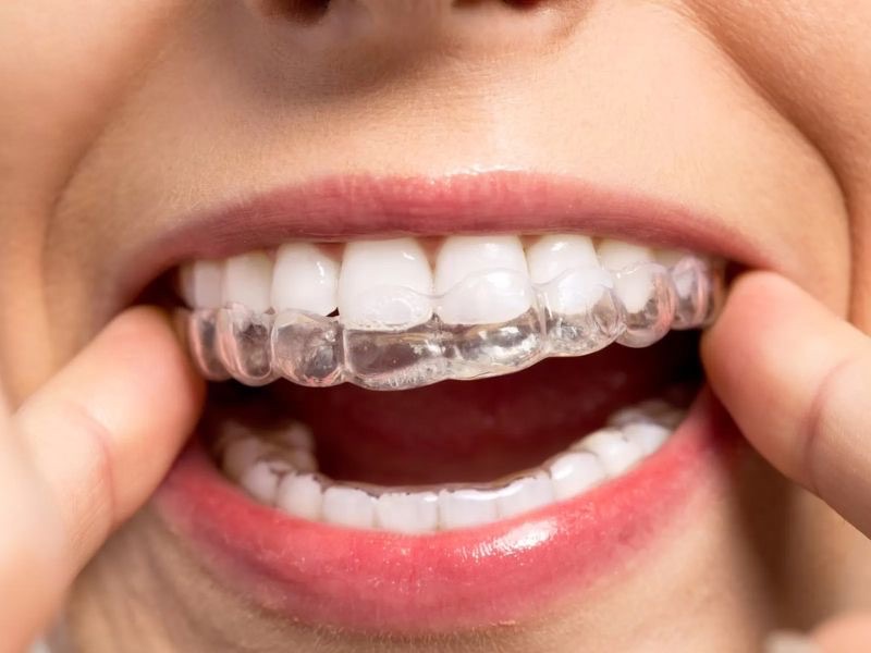 how-much-is-invisalign-cost-toronto-canada
