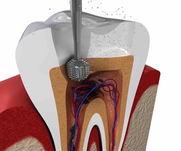 how-painful-is-root-canal-treatment