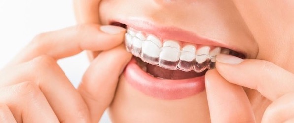 invisalign-los-angeles-for-teens