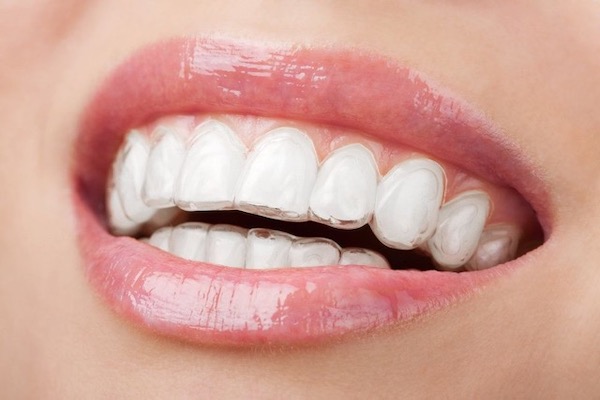 orthodontist-invisalign-before-and-after-los-angeles