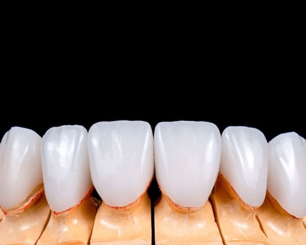 veneers-vs-crowns-which-one-is-better-for-you