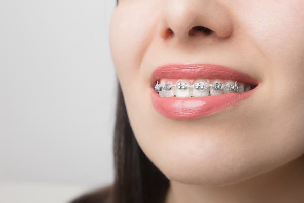 young-woman-smile-with-dental-braces-at-la-orthodontics