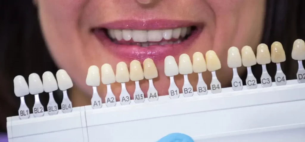 dental veneers from LA Dental Experts